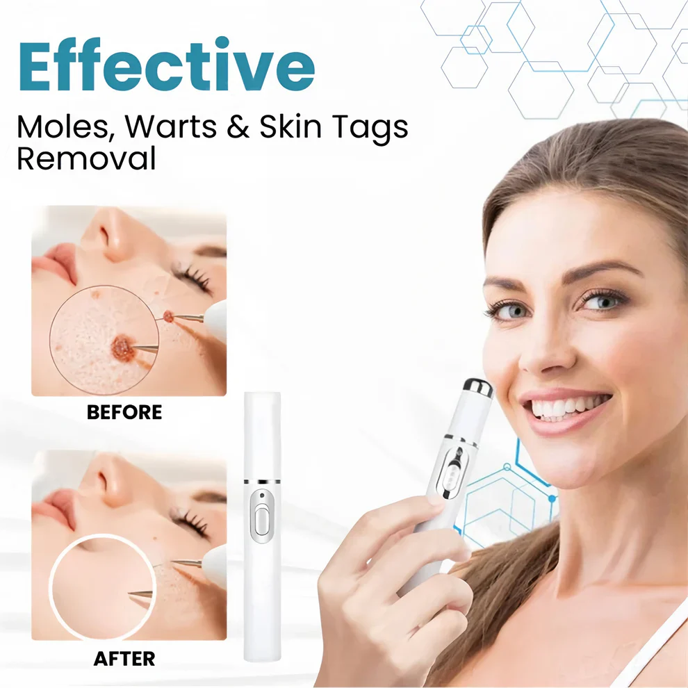 Aprolo™ Non-invasive Mole and Wart Removal Laser Pen - Image 12