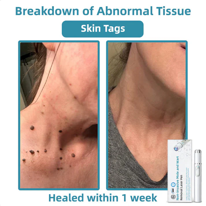 Aprolo™ Non-invasive Mole and Wart Removal Laser Pen - Image 5