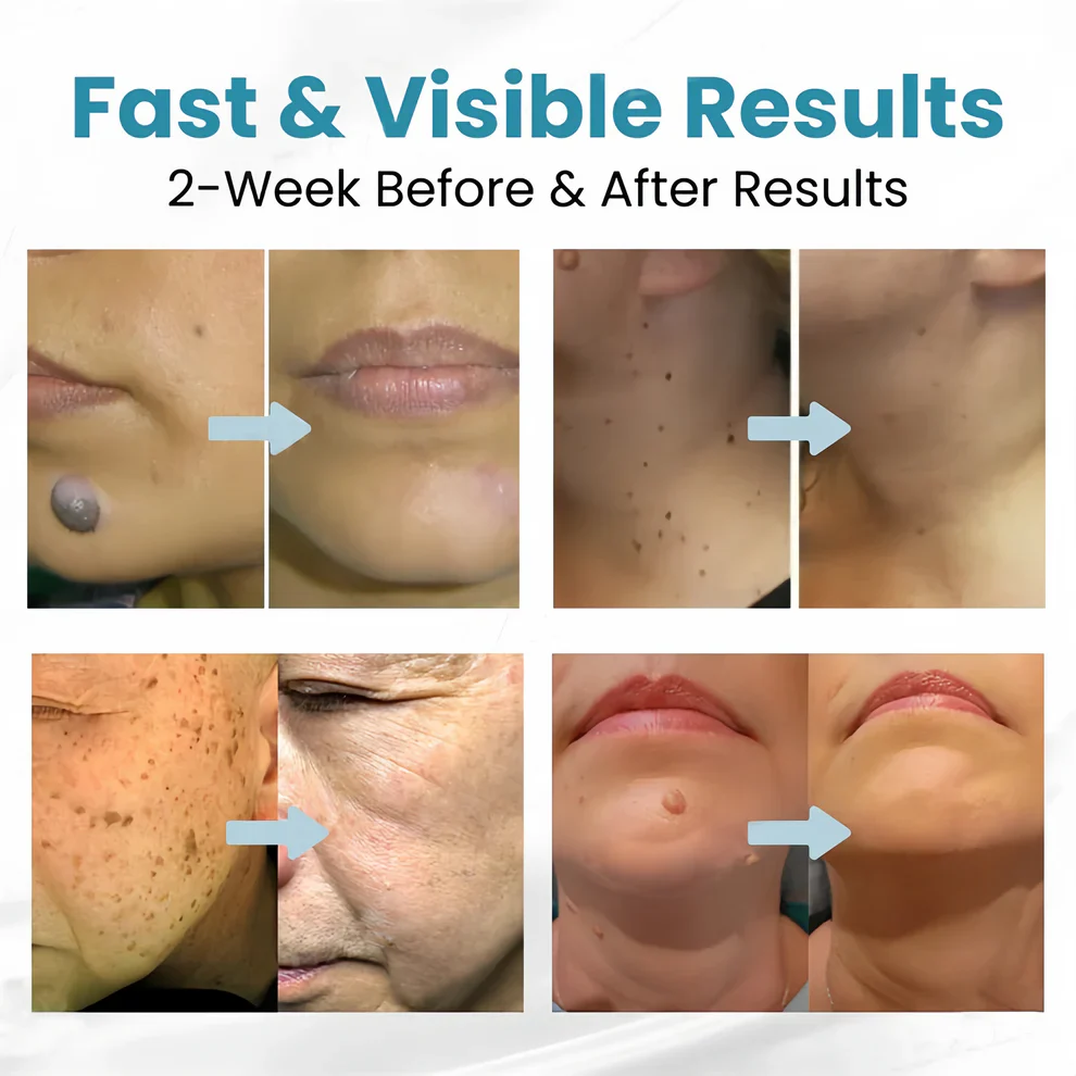 Aprolo™ Non-invasive Mole and Wart Removal Laser Pen - Image 7