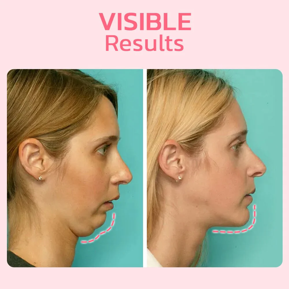 flysmus™ V Face Suction Beauty Trainer - Image 8