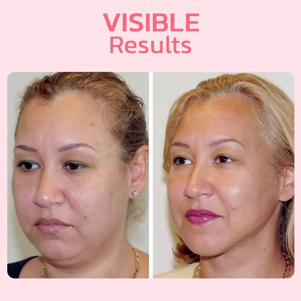 flysmus™ V Face Suction Beauty Trainer - Image 9